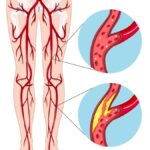 Periferik Arter Hastalığı nedir?